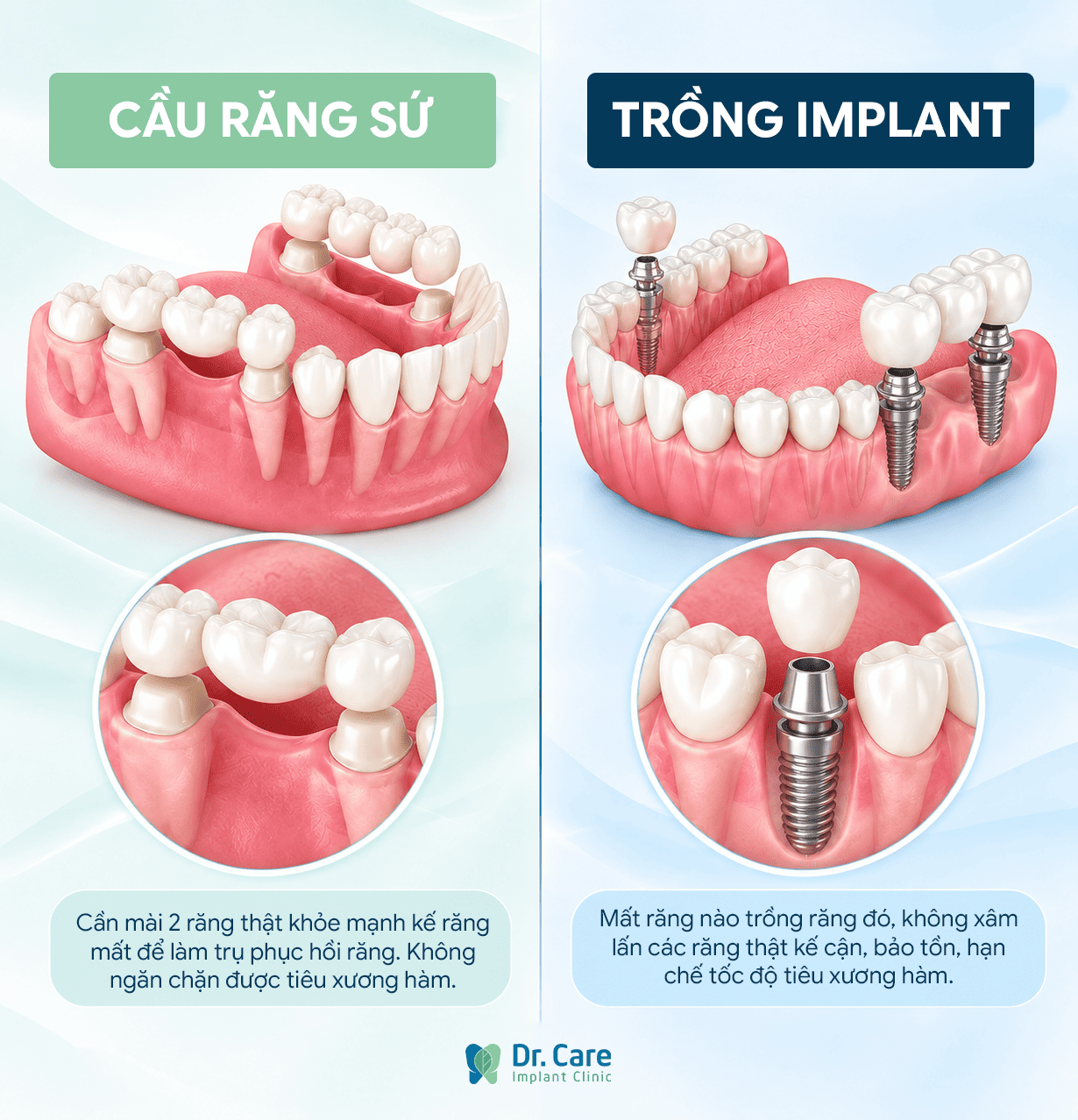 Ưu điểm trồng răng Implant toàn hàm
