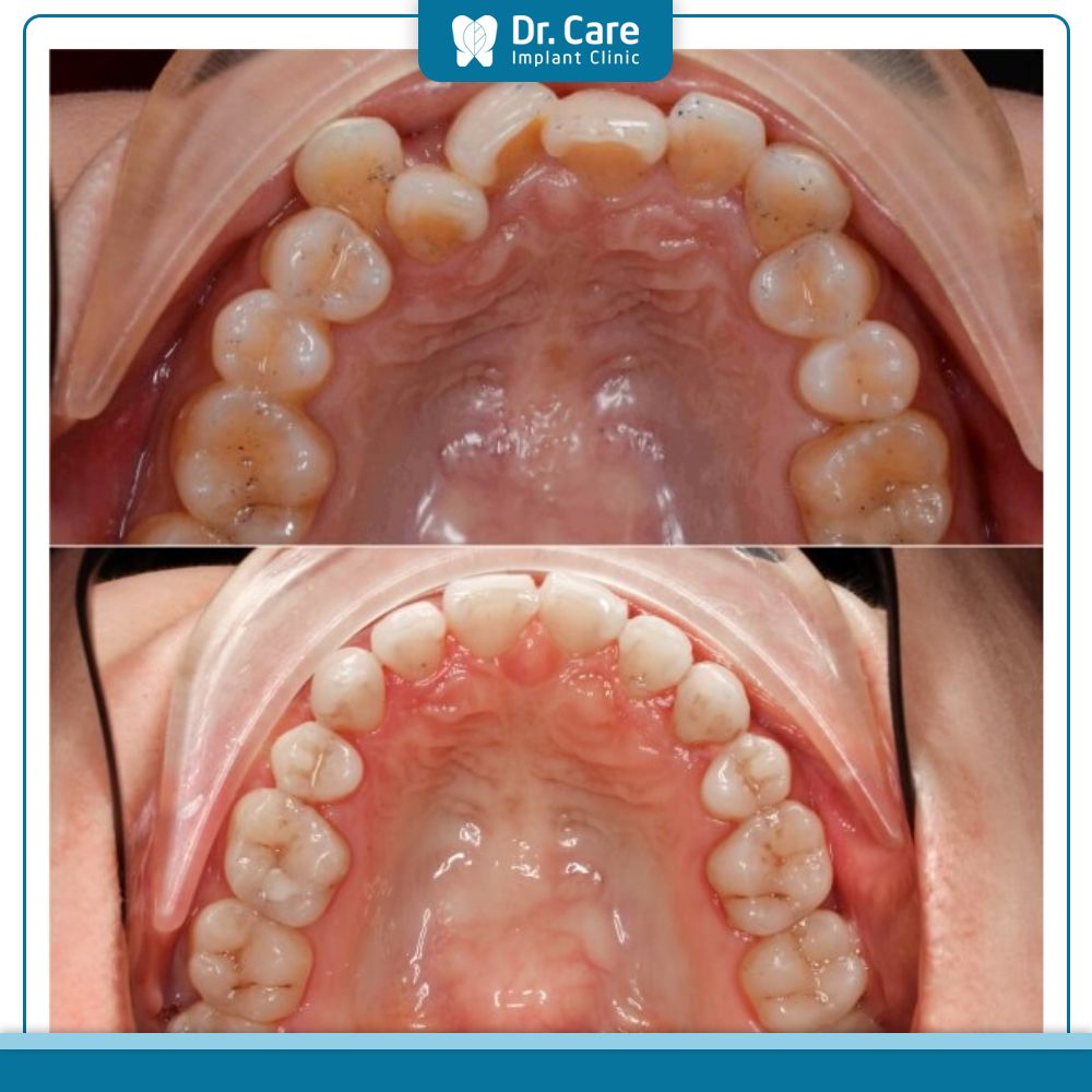Những trường hợp răng hư bắt buộc phải nhổ răng