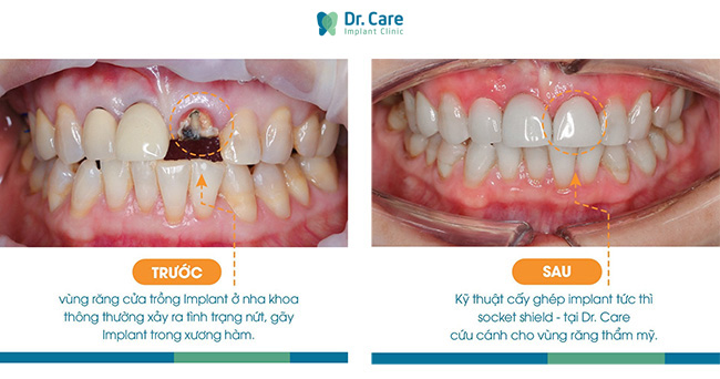 kỹ thuật trồng răng implant