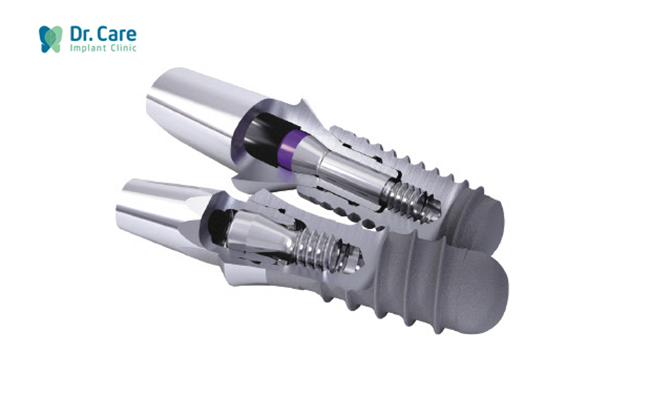abutment implant là gì