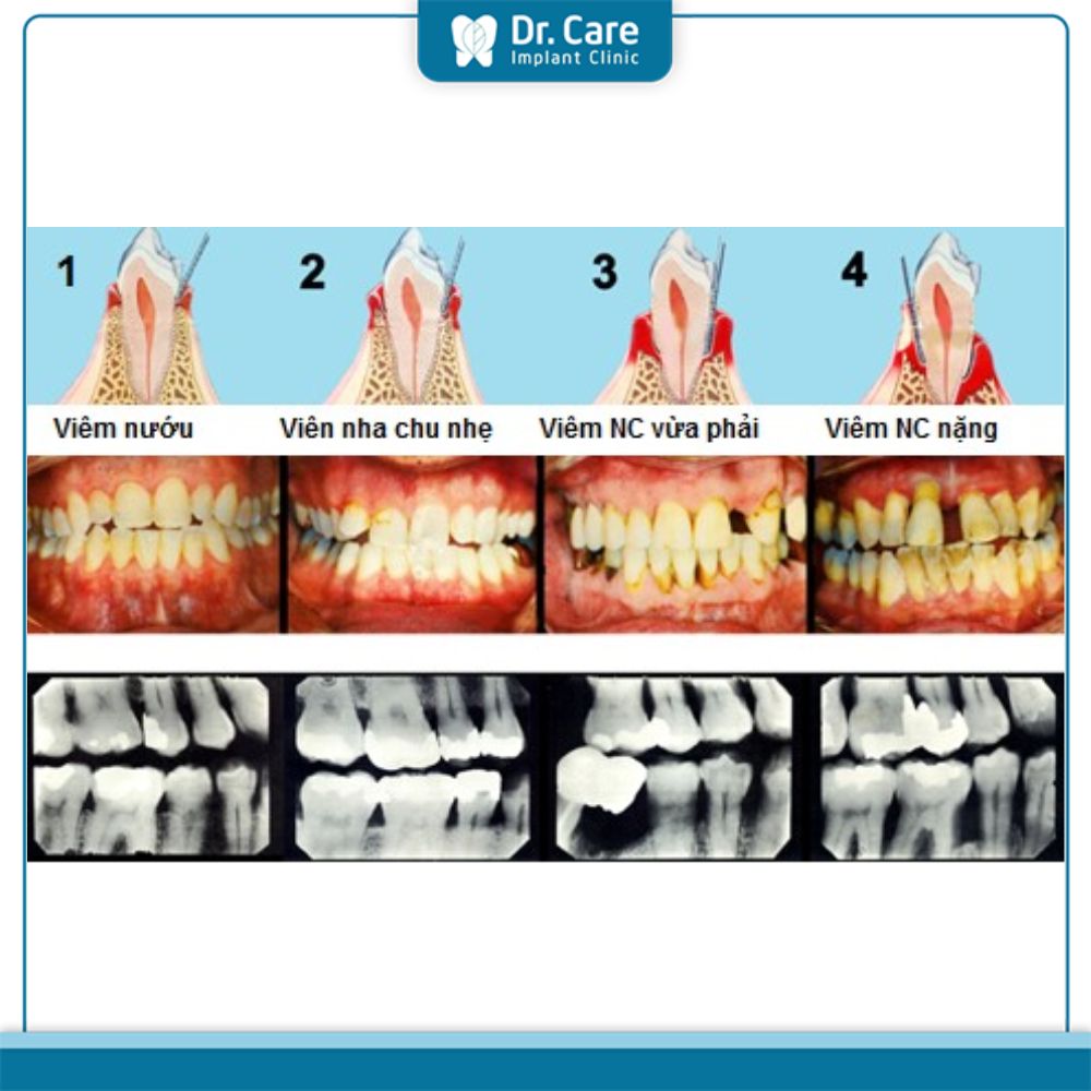 Các cấp độ viêm nha chu tiến triển theo giai đoạn