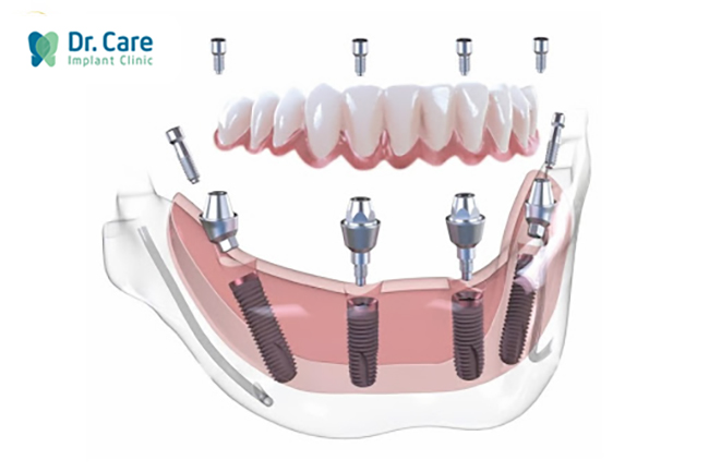 Kỹ thuật Implant toàn hàm All on 4 và All on 6 Kỹ thuật Implant toàn hàm All on 4 và All on 6