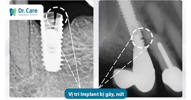 Trụ Implant kém chất lượng dễ bị toét, nứt, gãy kỹ thuât cấy ghép implant