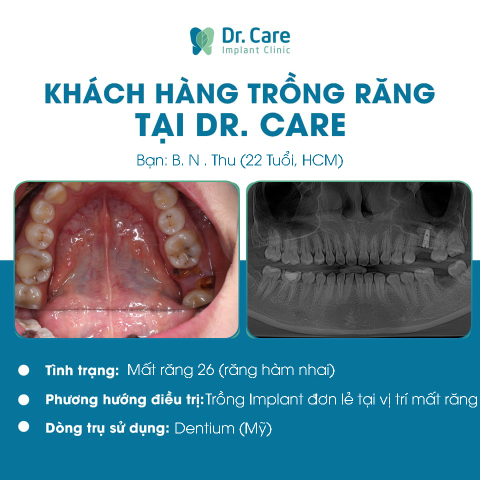 Phương pháp trồng răng Implant
