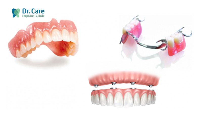 Mất răng nguyên hàm có trồng lại được không?