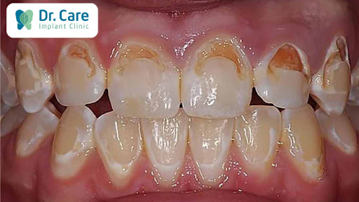 Vai trò quan trọng của canxi đối với răng