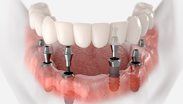 Phục hình hàm phủ tháo lắp trên Implant