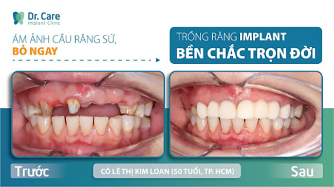 kỹ thuật cấy ghép implant