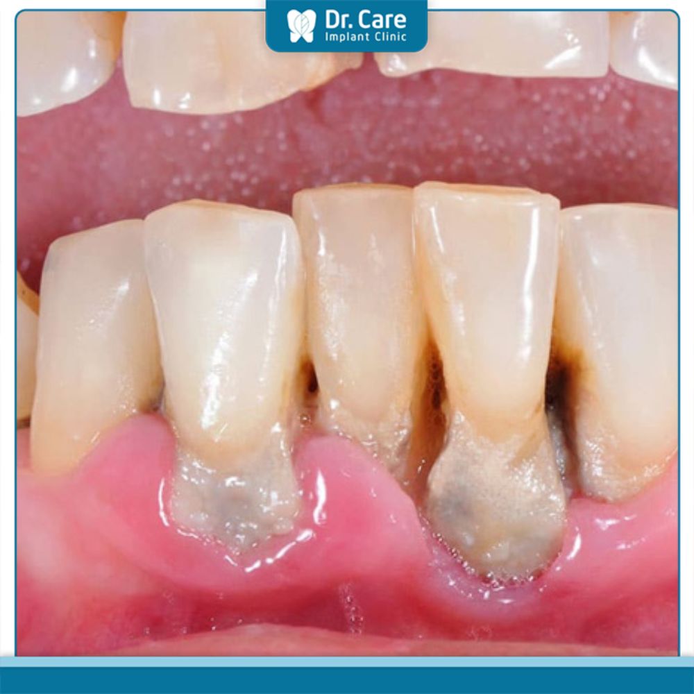 Người vệ sinh răng miệng kém có nguy cơ mắc viêm nha chu cao