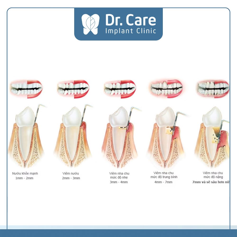  Viêm nha chu có 4 giai đoạn và có mức độ nhiễm bệnh tăng từ giai đoạn 1 đến giai đoạn 4