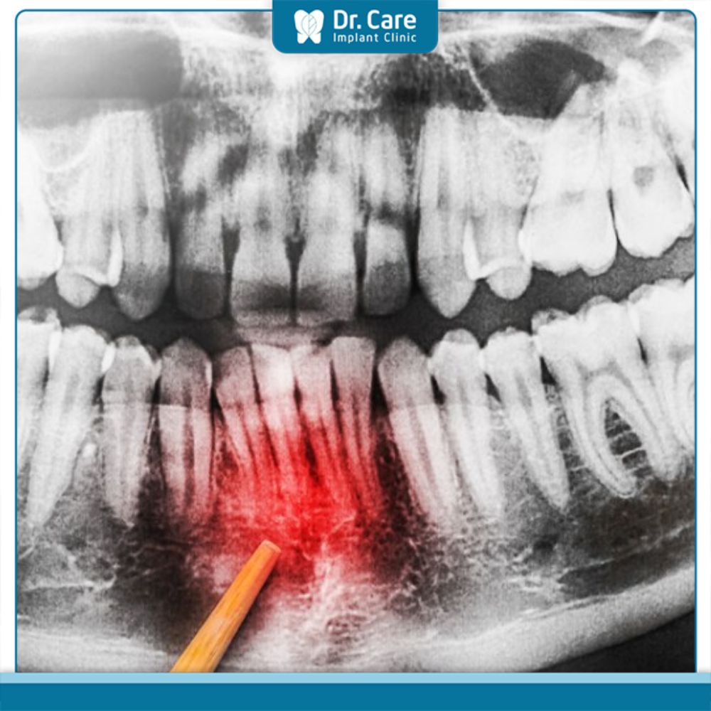 Xương ổ răng bị phá hủy do viêm nha chu
