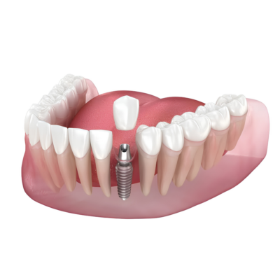 Trồng răng Implant đơn lẻ