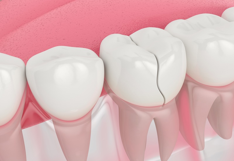 Nứt chân răng cũng là một vấn đề nghiêm trọng của sức khỏe răng miệng