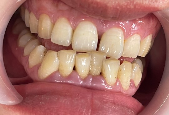 Răng thưa dễ bị giắt thức ăn vào kẽ răng