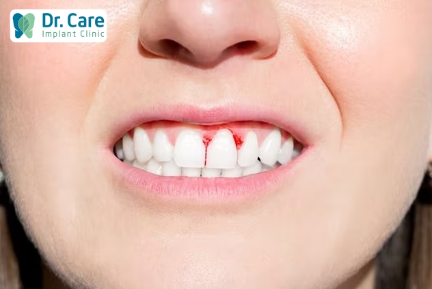 Không nên chủ quan khi bị chảy máu chân răng sau khi bọc răng sứ