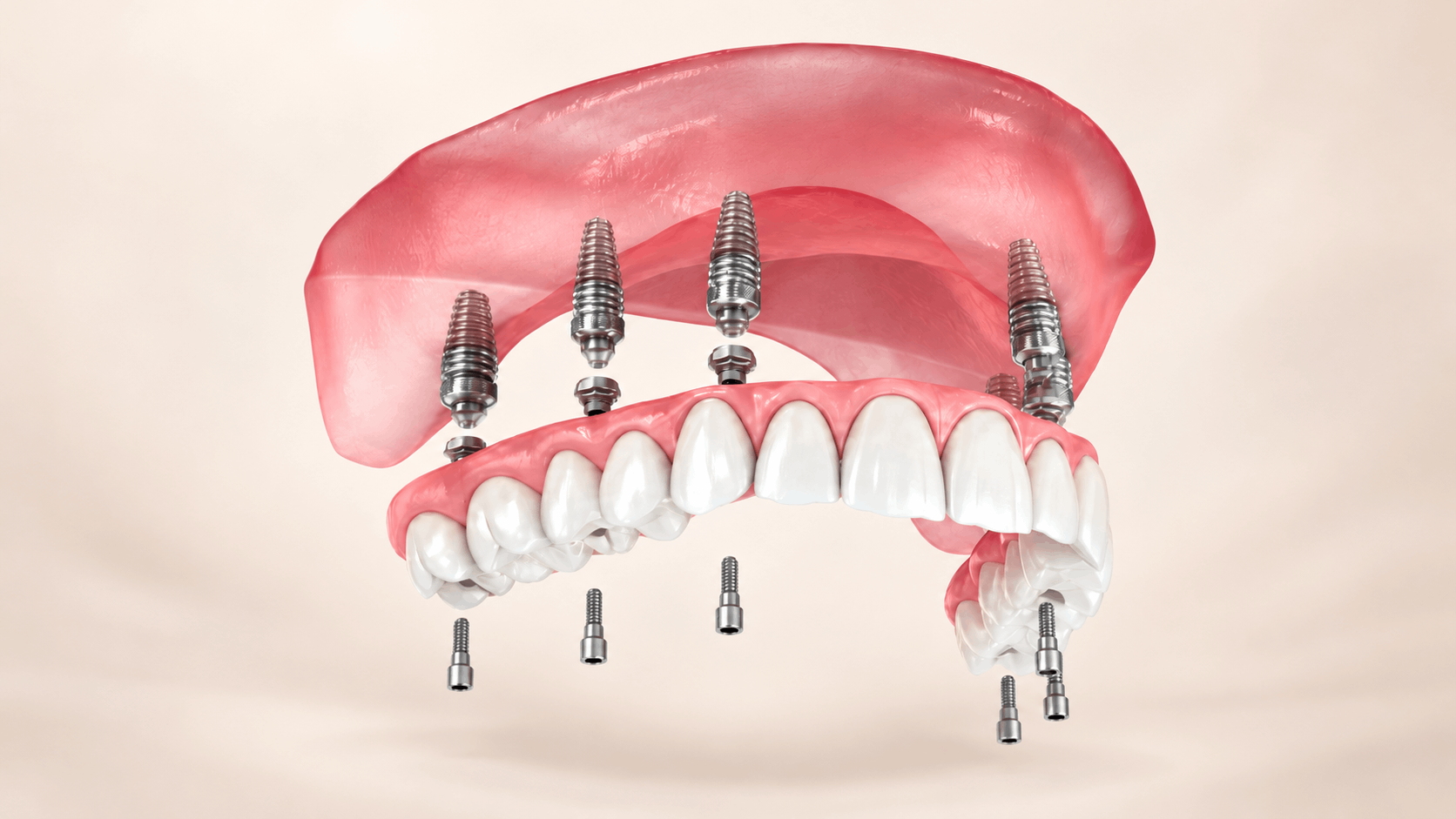 Phục hình cố định trên Implant toàn hàm