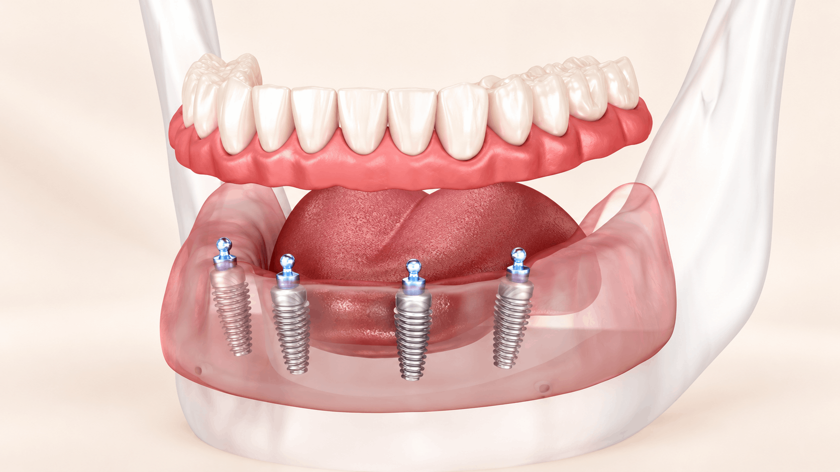 Phục hình cố định trên Implant toàn hàm