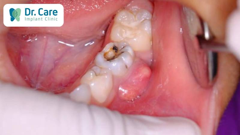 Mất răng là một trong những biến chứng nguy hiểm của áp xe chân răng