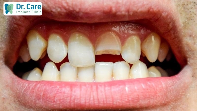 Nghiến răng khi đi ngủ có thể gây mòn răng