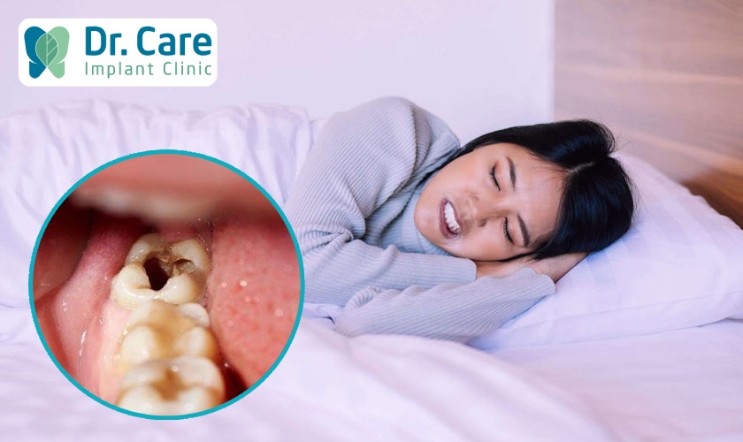 Sâu răng là nguyên nhân chính dẫn đến đau răng ban đêm