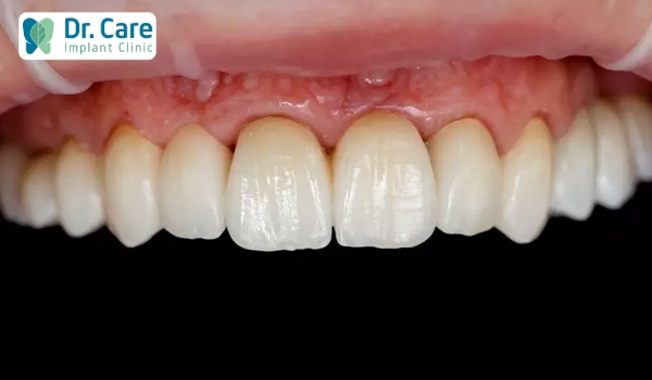 Bị đen viền chân răng cần sớm làm lại răng sứ