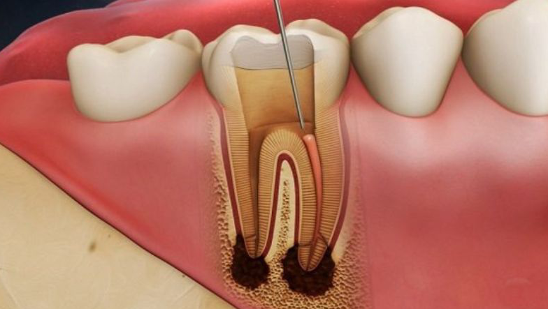 Răng chưa điều trị hết tủy dễ gây đau nhức