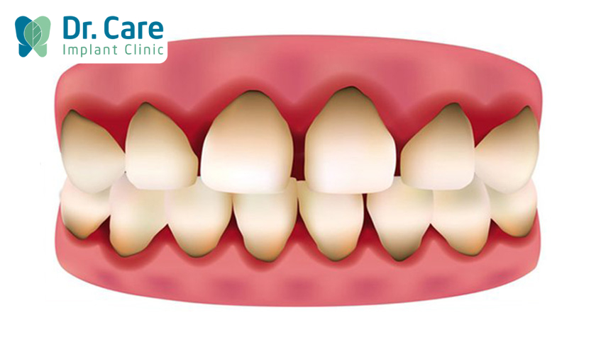 Răng sứ kim loại sử dụng một thời gian sẽ bị đen viền nướu
