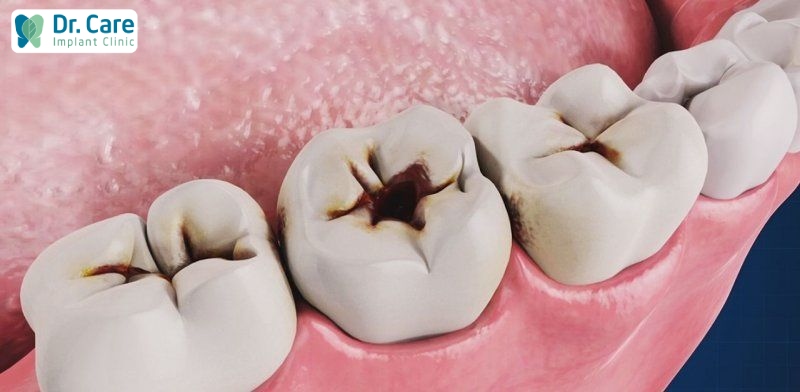Nếu không điều trị sâu răng sớm sẽ làm tăng mức độ đau nhức