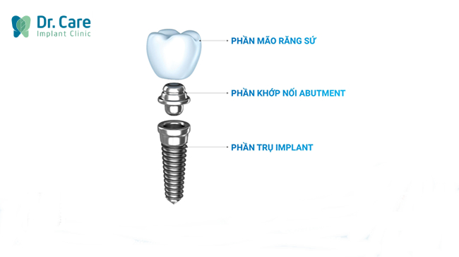 Sau khi cấy ghép, răng Implant sẽ đảm bảo chức năng ăn nhai và thẩm mỹ gần như răng thậ