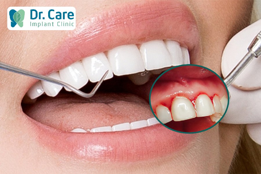 Cần hết sức lưu ý nếu bị chảy máu chân răng sau khi làm răng sứ