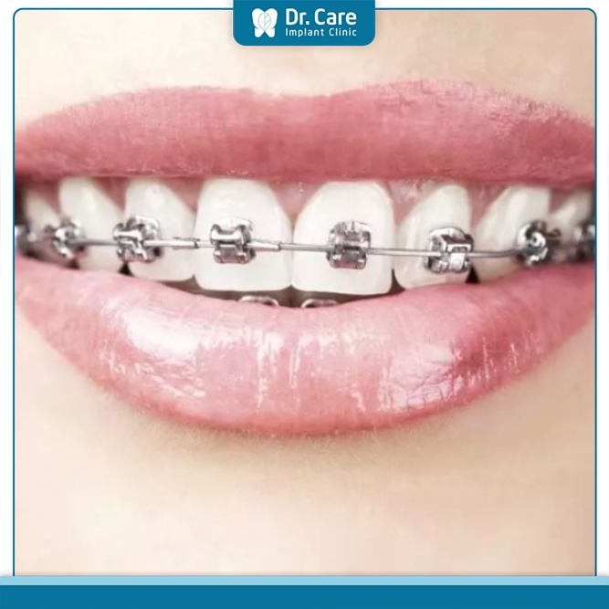 Chi phí niềng răng mắc cài tự buộc cao hơn niềng răng truyền thống