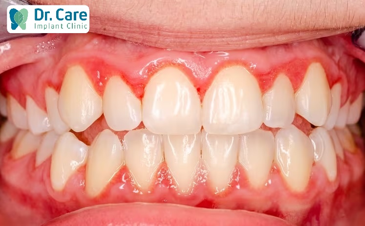 Viêm nướu sẽ dẫn đến tình trạng chảy máu chân răng