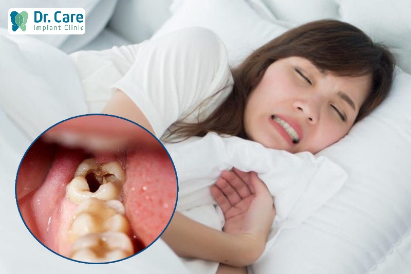 Sâu răng chuyển biến sang sốt cao