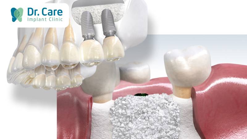 Trong trường hợp mất răng lâu năm bác sĩ sẽ tiến hành ghép xương để trồng răng Implant