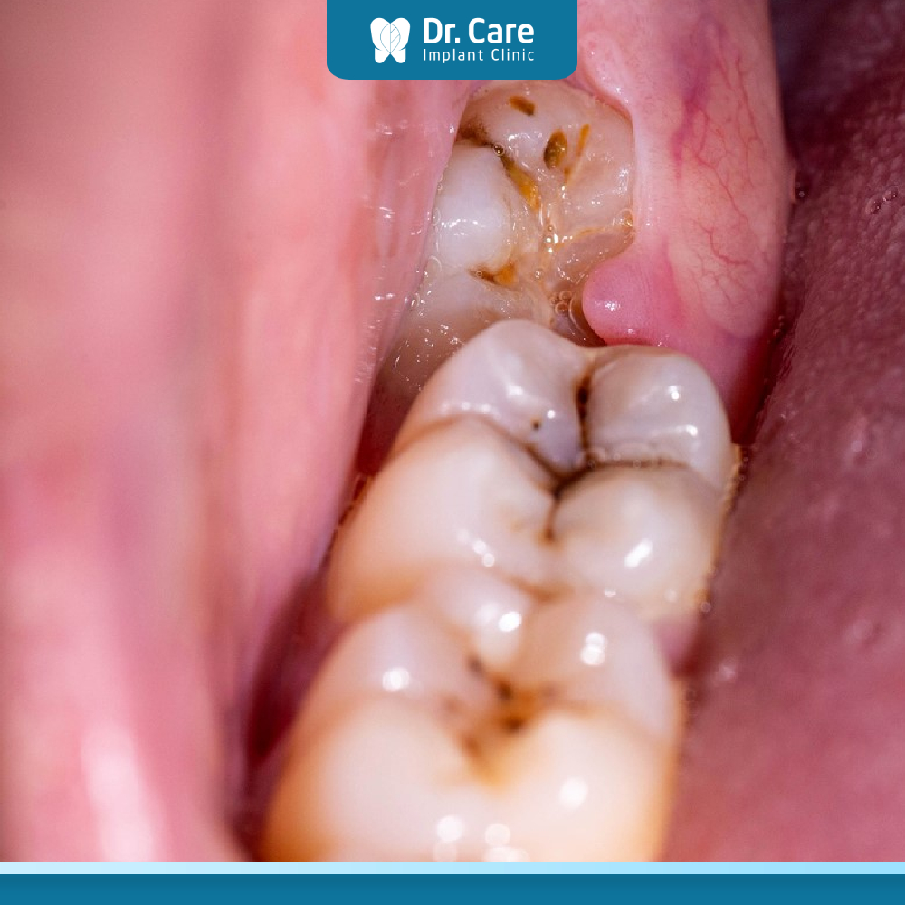 Tình trạng răng khôn mọc lệch gây đau nhức và sưng nướu là dấu hiệu cảnh báo viêm nhiễm cần được xử lý kịp thời