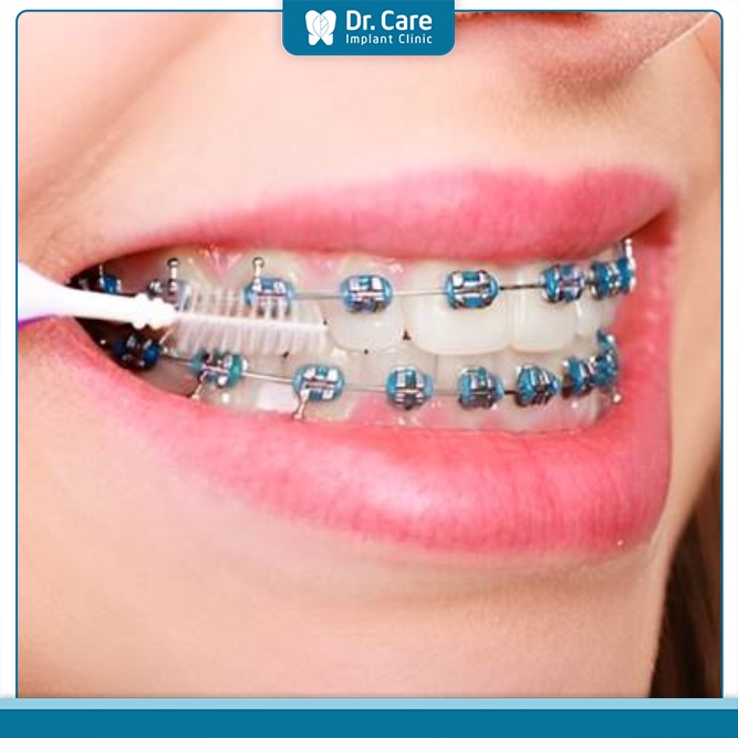 Cần vệ sinh răng niềng đúng cách