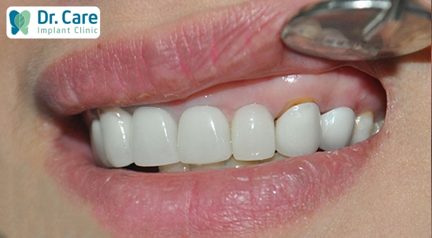 Nhận biết sớm các dấu hiệu răng sứ bị hở sẽ giúp khắc phục tình trạng này