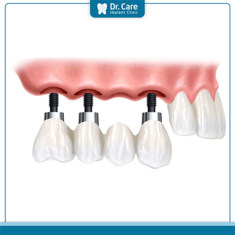 Cấy ghép Implant cho 4 răng liên tiếp