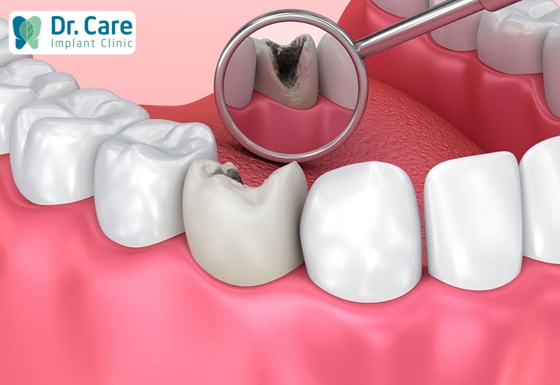 Sâu răng ở mức độ nhẹ chỉ làm hơi đau nhức mà không có thêm triệu chứng nào khác