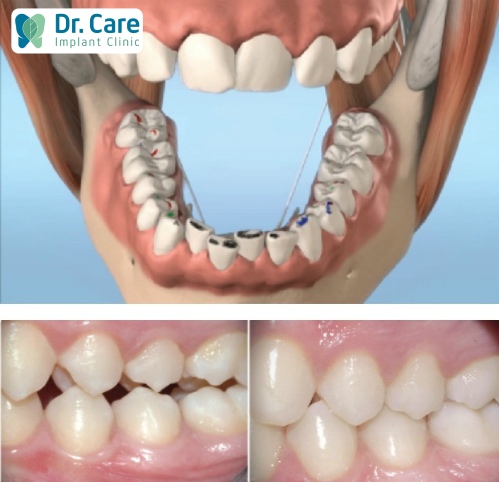 Lệch khớp cắn ảnh hưởng đến khả năng ăn nhai