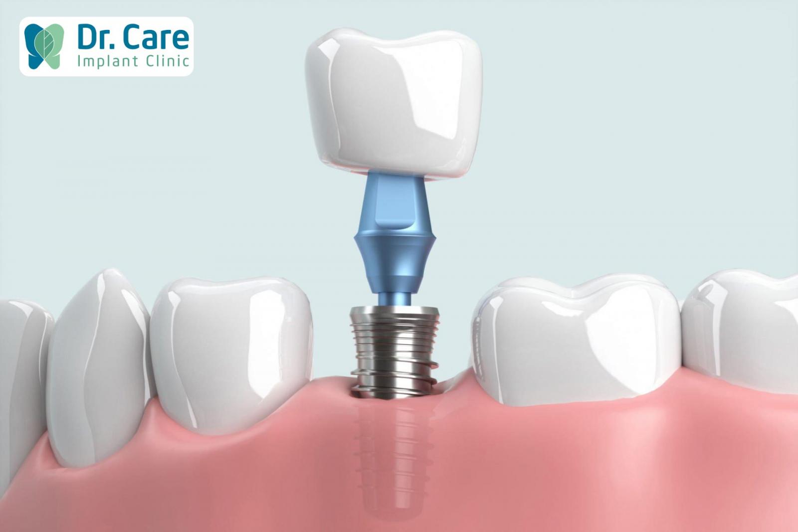 Răng sâu nặng cần nhổ bỏ để trồng Implant