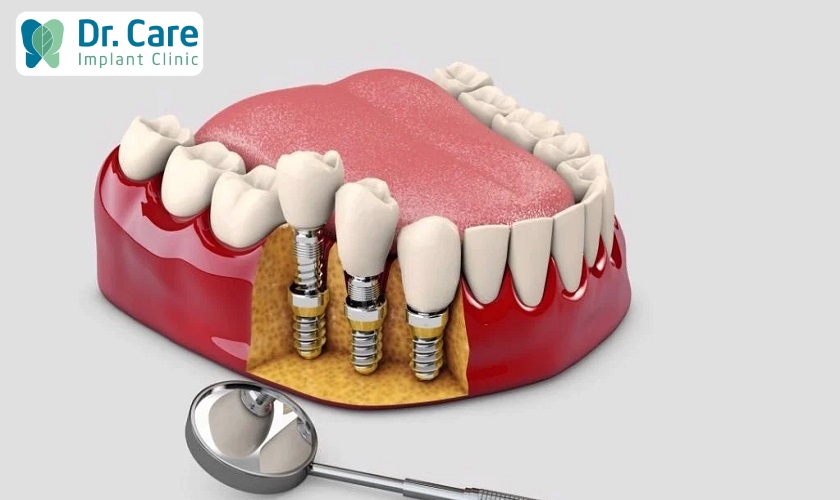 Mất răng lâu năm vẫn có thể trồng răng Implant Pháp