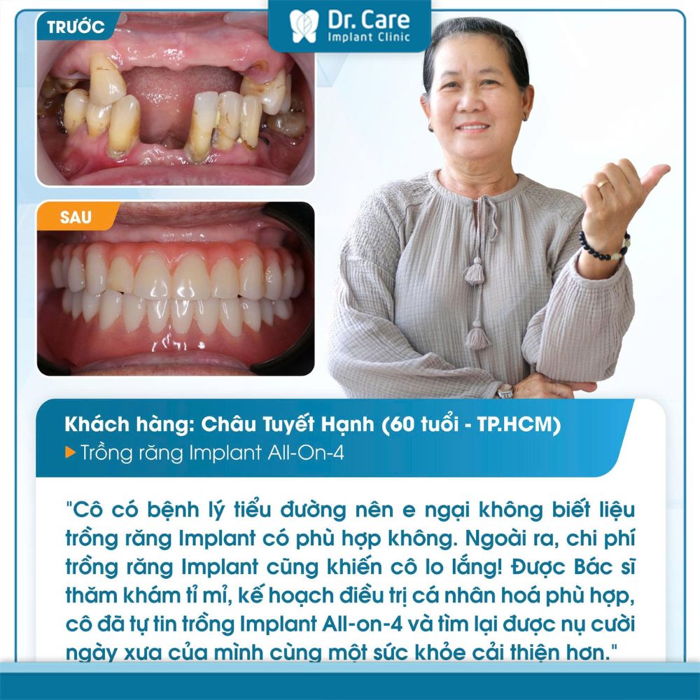 Phương pháp phục hình 4 răng liên tiếp chỉ với 2 trụ Implant