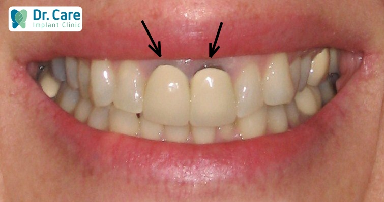 Nhược điểm của răng sứ kim loại là dễ bị đen viền răng 