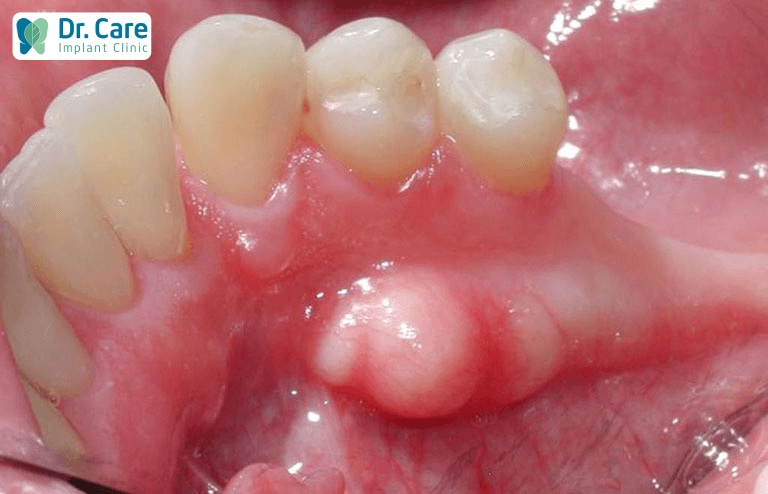 Khi bị sưng viêm, nổi hạch cần điều trị triệt để trước khi cấy ghép Implant