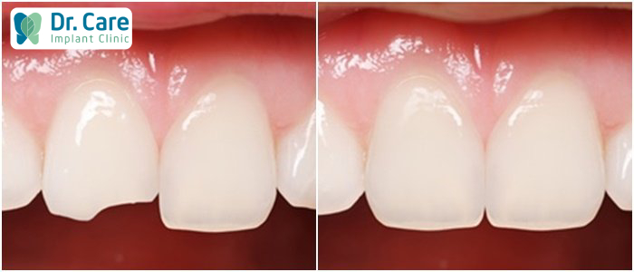 Răng bị vỡ mẻ khắc phục như thế nào?