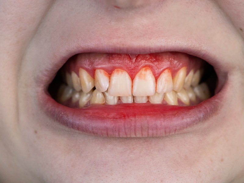 Răng sứ bị viêm nướu làm chảy máu chân răng