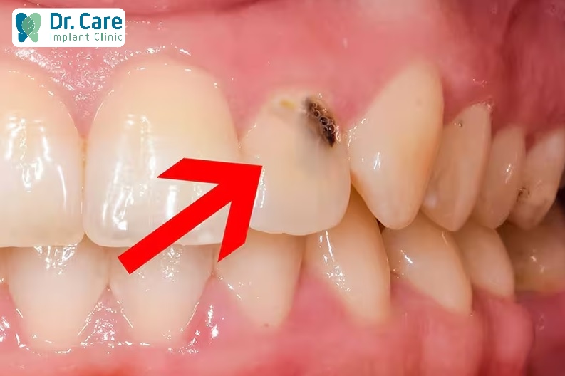 Đây là biểu hiện bị sâu răng điển hình nhất
