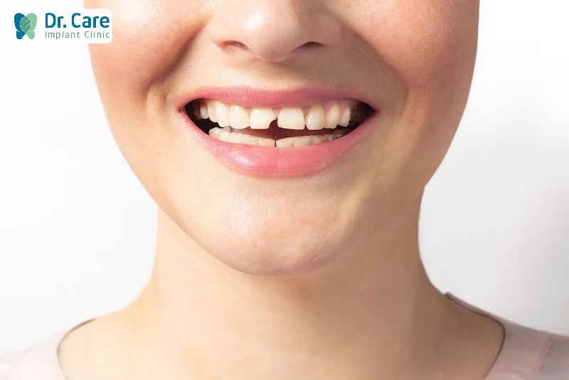 Bọc răng sứ bị mẻ hoàn toàn có thể thay mão sứ mới
