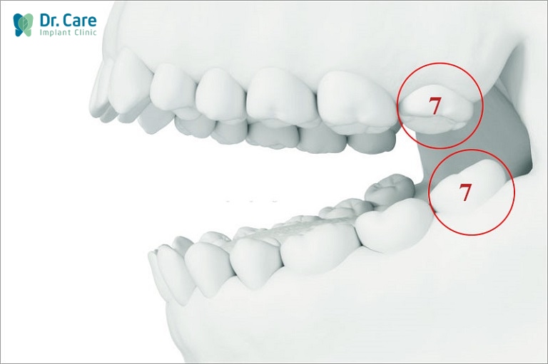 mất răng số 7 hàm trên